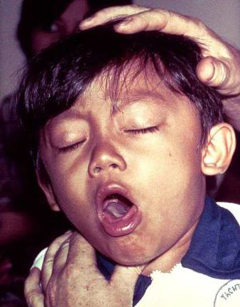 Whooping Cough Cases Triple in New York State Whooping Cough Cases Triple in New York State
